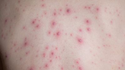 Sobe para 98 o número de casos confirmados de mpox na Paraíba